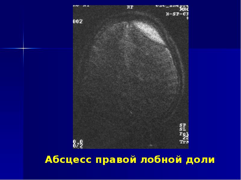 Риногенные орбитальные и внутричерепные осложнения презентация