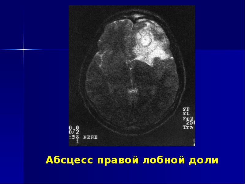 Риногенные внутричерепные осложнения презентация