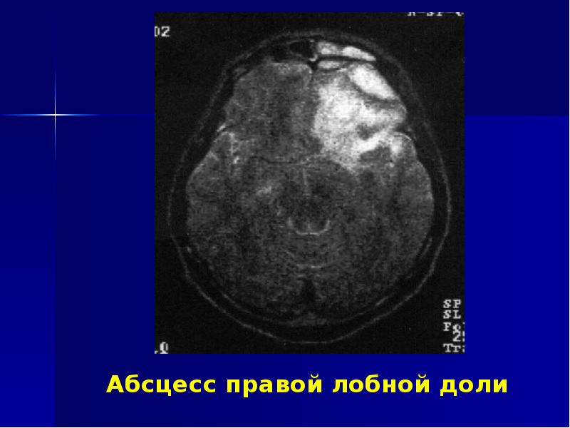 Риногенные внутричерепные осложнения презентация