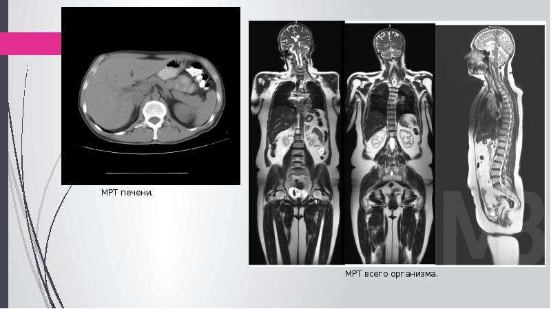 Магнитно резонансная томография презентация