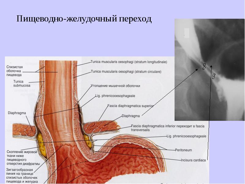 Сфинктер проходим. Пищеводно-желудочный переход. Пищеводно желудочный сфинктер.