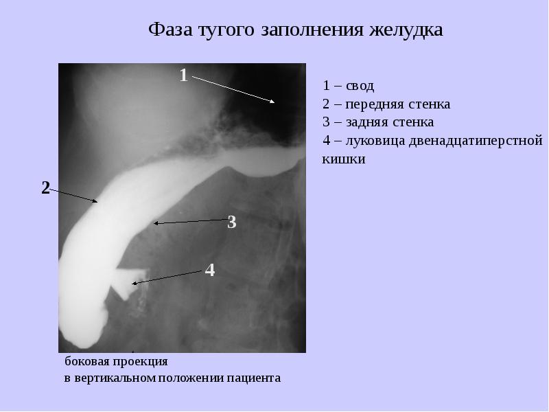 Пищевод складки слизистой. Рентгеноанатомия грудной клетки. Рентген анатомия пищевода и желудка. Нормальная рентгеноанатомия желудка.