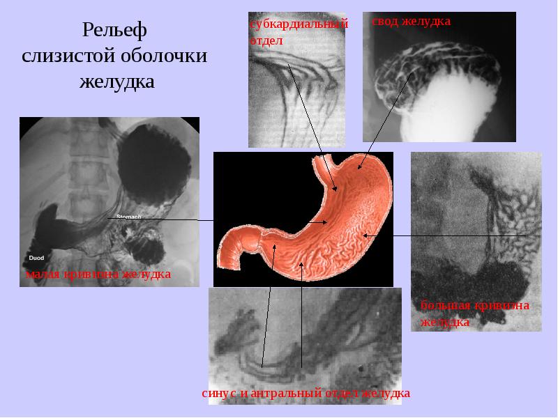 Где находится антральный отдел. Антральный отдел желудка. Антрального отдела желудка. Слизистая антрального отдела желудка. Язва антрального отдела.