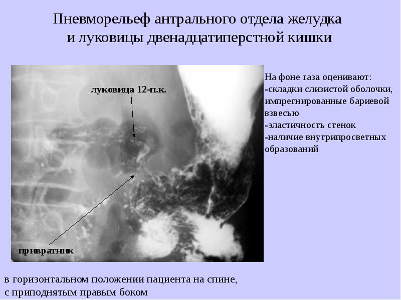 Где находится антральный отдел желудка у человека фото и описание