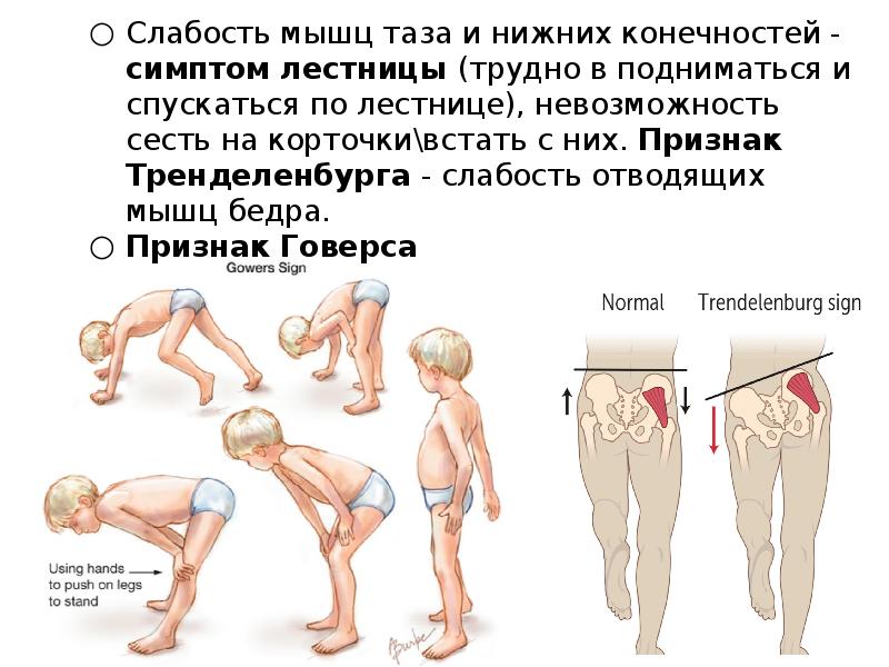 Ювенильный артрит с системным началом презентация