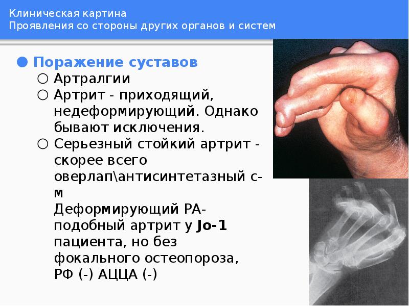 Клиническая картина Проявления со стороны других органов и систем