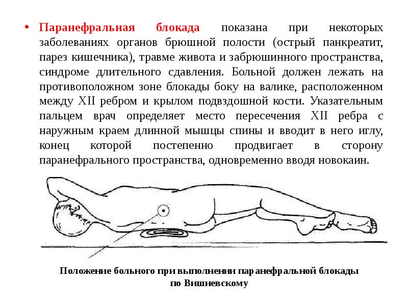 Методика проведения паранефральной блокады. Поясничная паранефральная новокаиновая блокада. Паранефральная блокада по Вишневскому.