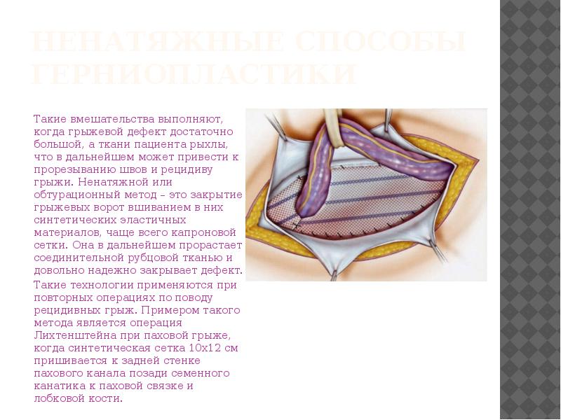 Грыжа передней брюшной стенки