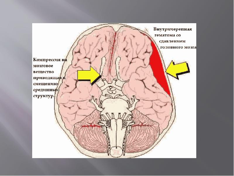 Проведенные на головном мозге. Факторы сдавления головного мозга. Сдавление головного мозга гематомой. Сдавление головного мозга внутричерепными гематомами. Симптомы сдавления головного мозга.