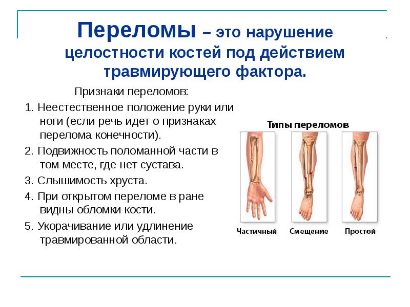 Переломы верхних конечностей презентация