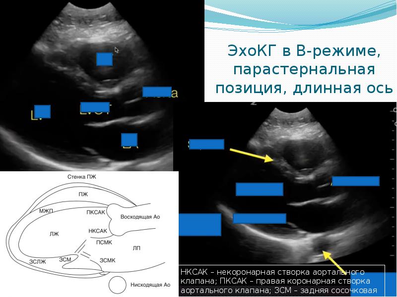 Эхо кг стенки