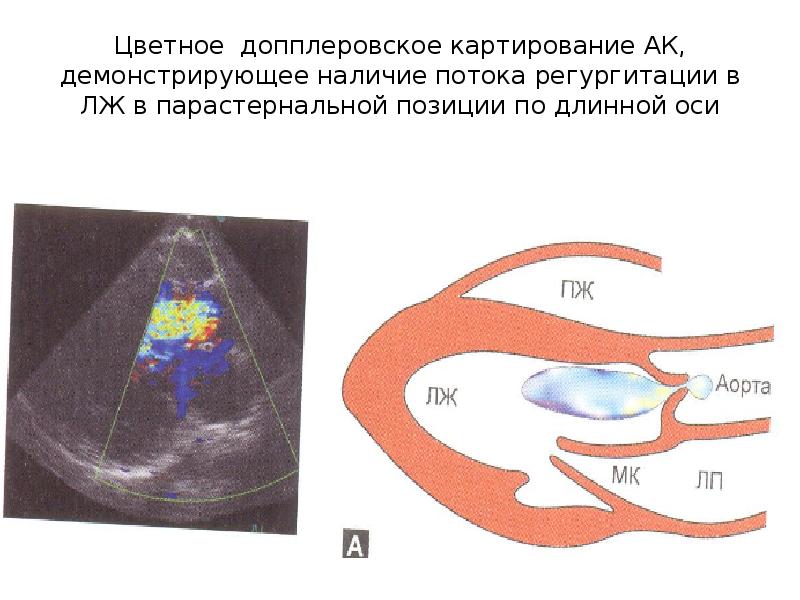 Аортальная регургитация. Допплеровское картирование. Цветное допплеровское картирование. Цветное допплеровское картирование аорта.