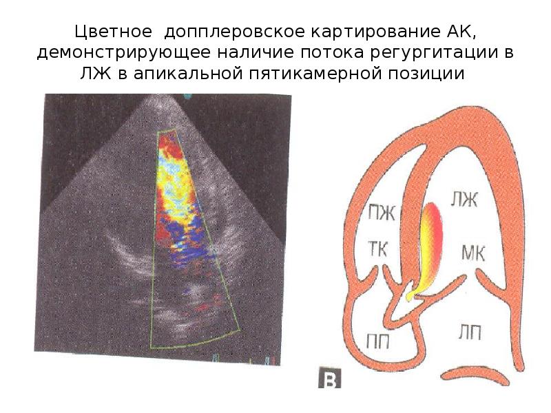 Аортальная регургитация. PHT аортальной регургитации. ЭХОКГ при аортальной регургитации. Цветное допплеровское картирование. Степень аортальной регургитации Эхо.