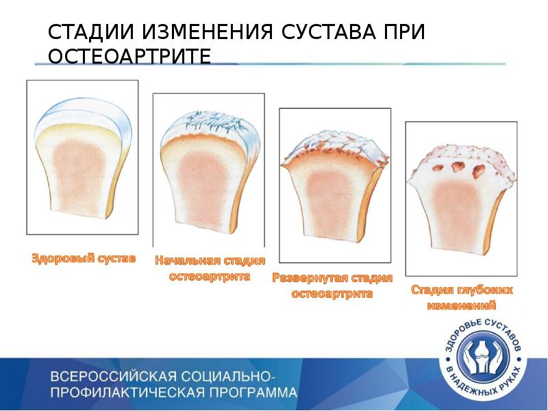 Конечная стадия