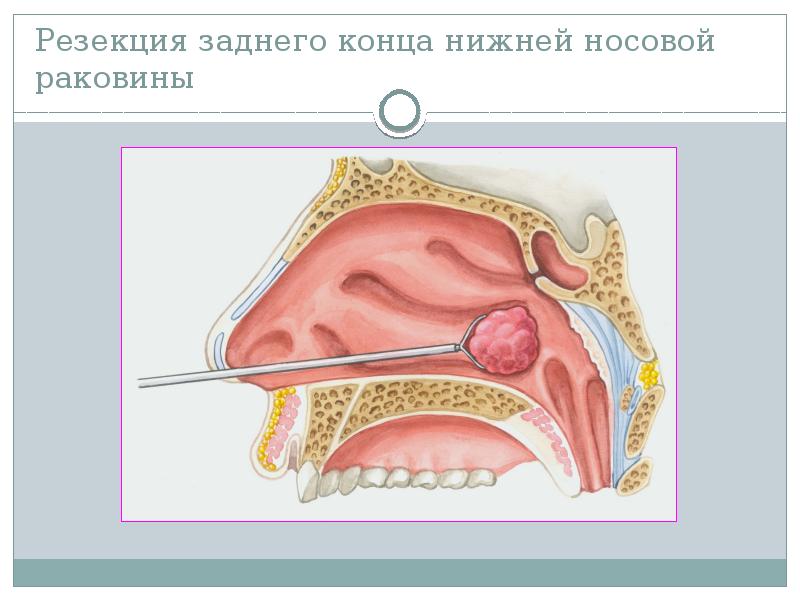 Презентация на тему ринит