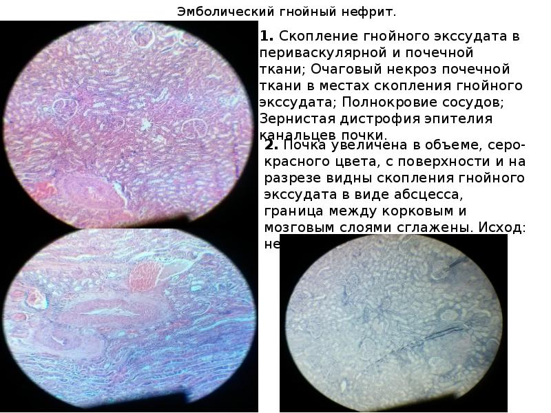 Эмболический гнойный нефрит микропрепарат рисунок