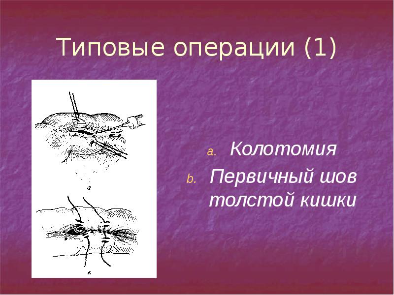 Первичный шов раны