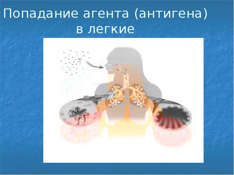 Попадание агента (антигена) в легкие Попадание агента (антигена) в легкие