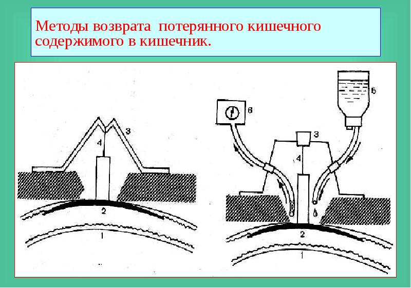 Кишечные свищи презентация