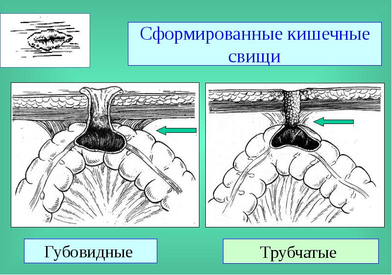 Свищи хирургия презентация