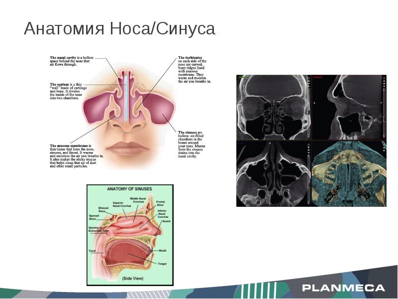 Как устроен нос внутри у человека фото Ухо-Горло-Нос (ЛОР) Planmeca ProMax ® 3D Mid и Planmeca ProMax ® 3D Max