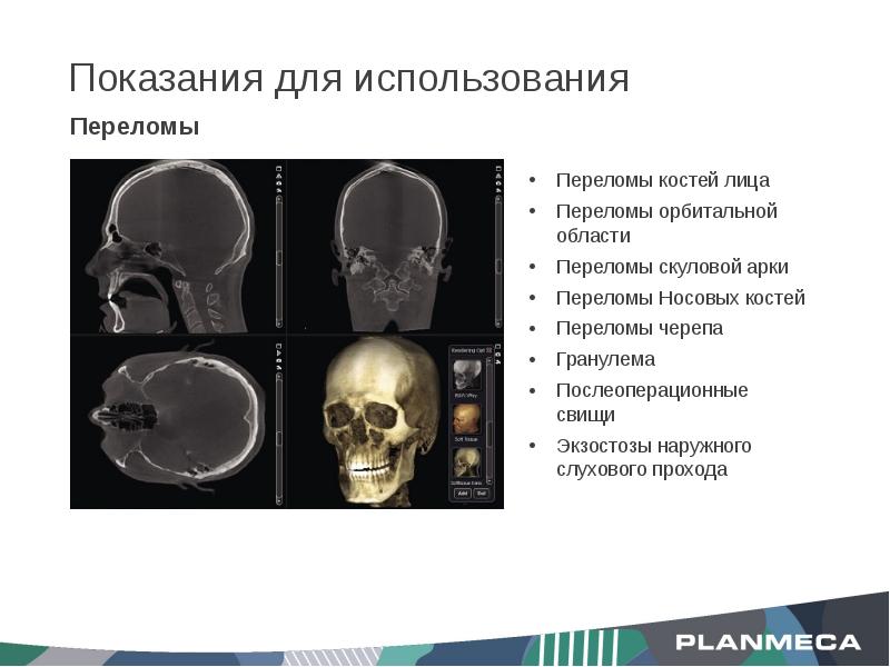 Перелом орбитальной кости. Перелом орбитальной Кост.