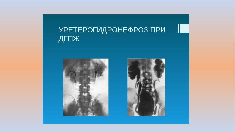 Гидронефроз у детей презентация