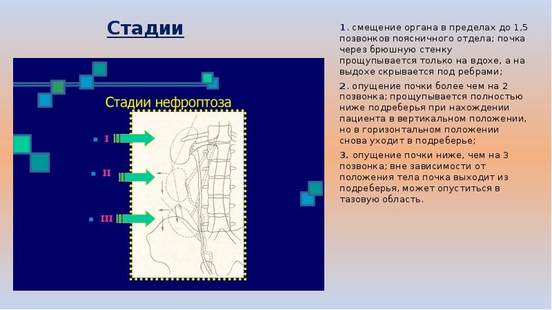 Нефроптоз стадии клиническая картина диагностика лечение