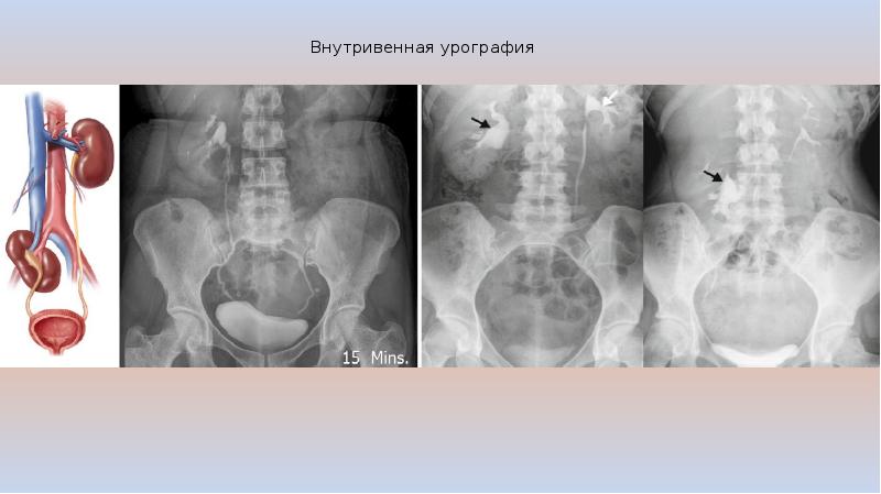 Гидронефроз у детей презентация