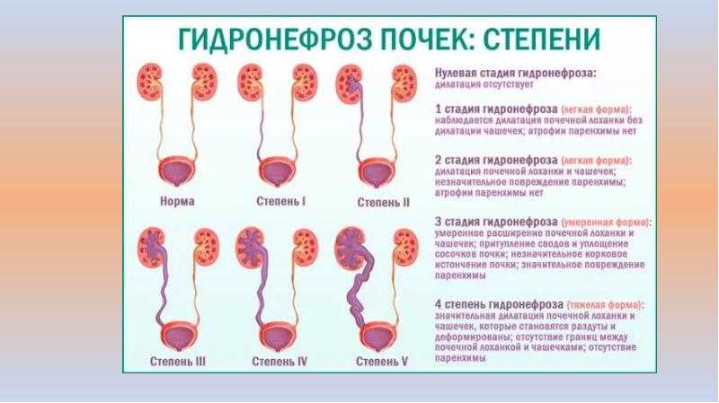 Гидронефроз у детей презентация