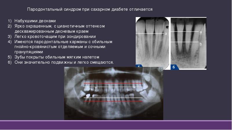 Операция при сахарном диабете. Пародонтальный синдром при сахарном диабете. Пародонтальный синдром при сахарном. Проявление сахарного диабета в полости рта. Изменения в полости рта при сахарном диабете.