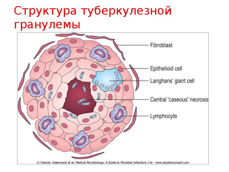 Туберкулезная гранулема рисунок