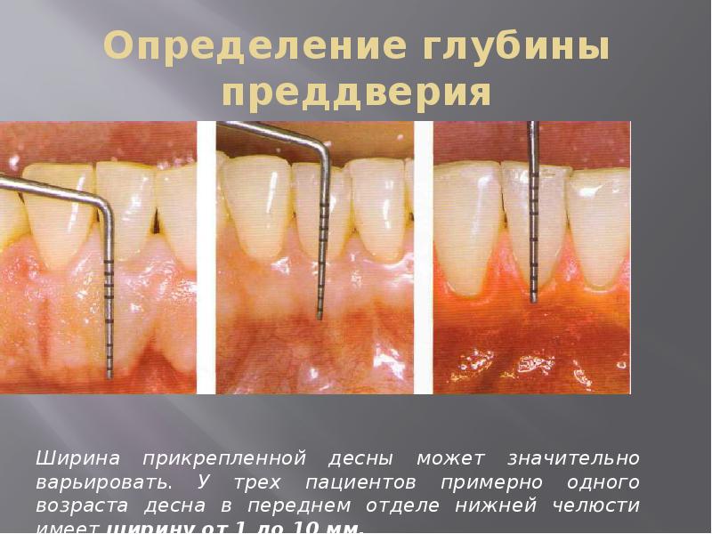 Определение глубины преддверия
Ширина прикрепленной десны может значительно варьировать. У трех Определение глубины преддверия
Ширина прикрепленной десны может значительно варьировать. У трех