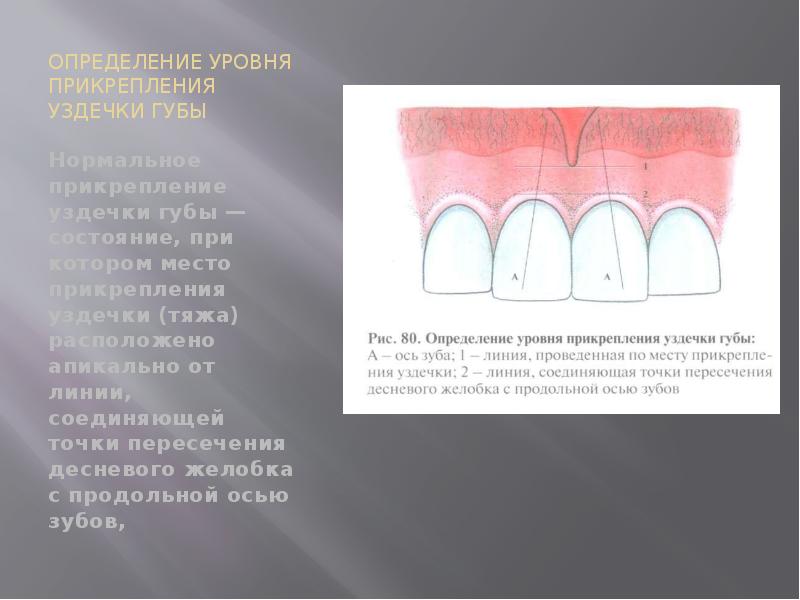 ОПРЕДЕЛЕНИЕ УРОВНЯ ПРИКРЕПЛЕНИЯ УЗДЕЧКИ ГУБЫ
Нормальное прикрепление уздечки губы — состояние, ОПРЕДЕЛЕНИЕ УРОВНЯ ПРИКРЕПЛЕНИЯ УЗДЕЧКИ ГУБЫ
Нормальное прикрепление уздечки губы — состояние,