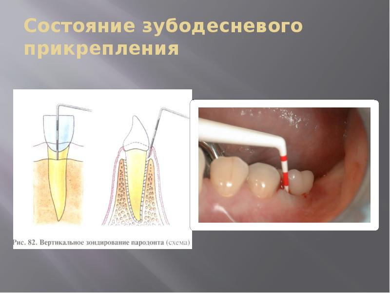 Состояние зубодесневого прикрепления Состояние зубодесневого прикрепления