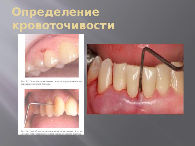 Определение кровоточивости Определение кровоточивости