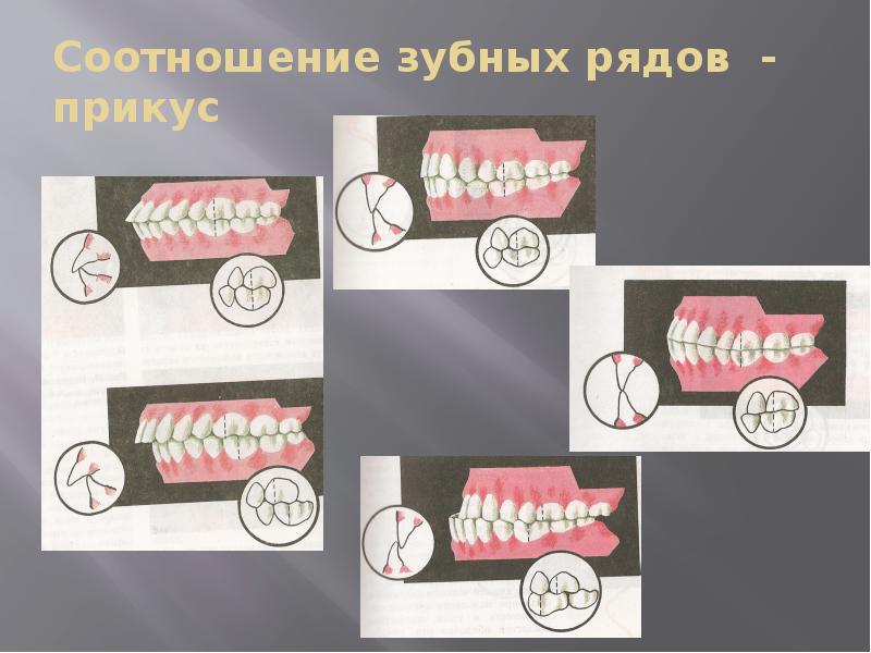 Соотношение зубных рядов - прикус Соотношение зубных рядов - прикус