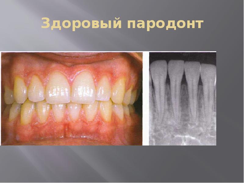Здоровый пародонт Здоровый пародонт