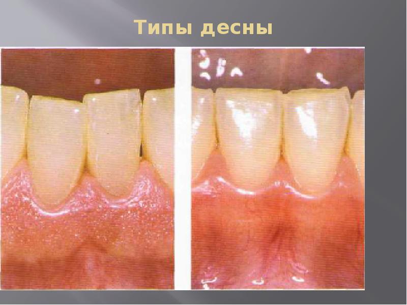 Типы десны Типы десны