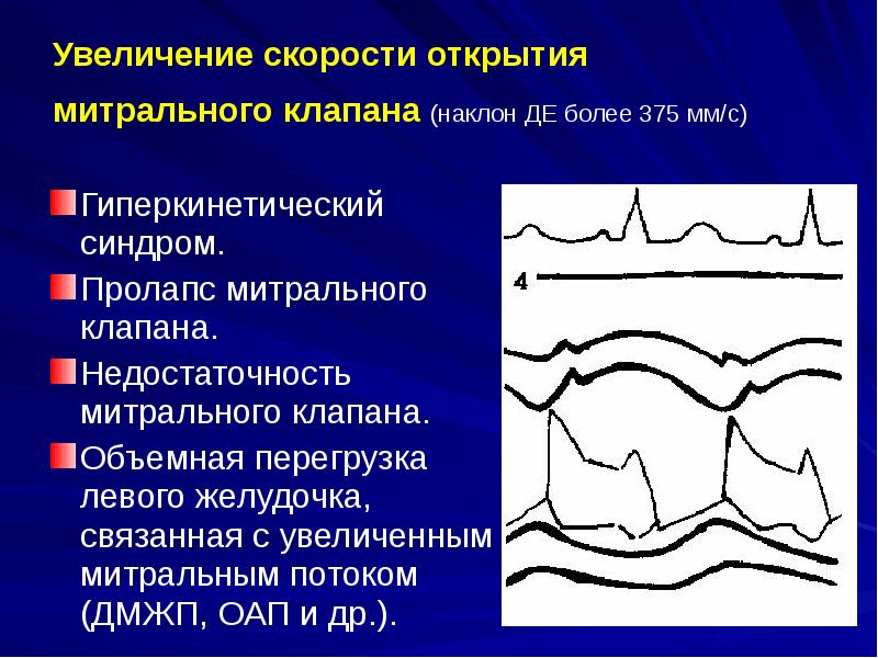 Тон открытия митрального клапана