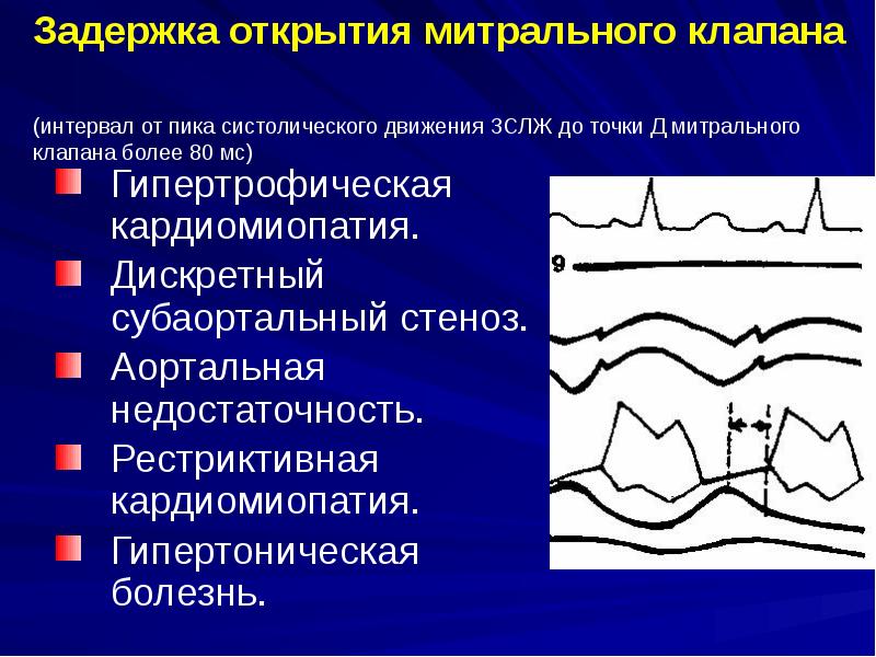 Тон открытия митрального клапана