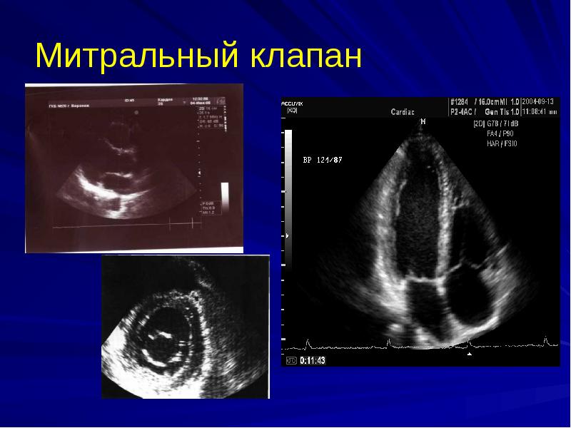 Прогиб стенки митрального клапана 1 степени