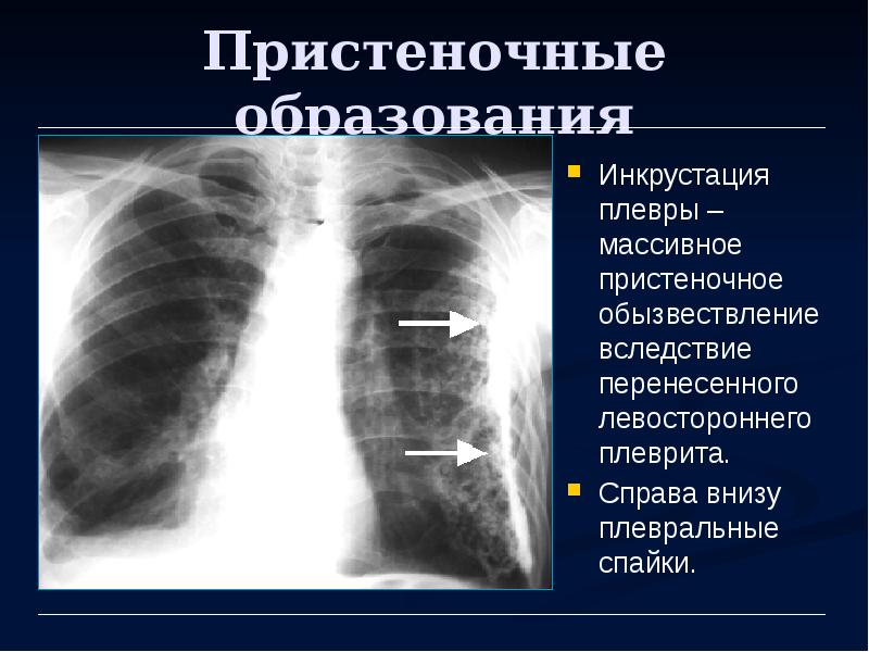 Рентгенологическую картину выпотного плеврита определяют