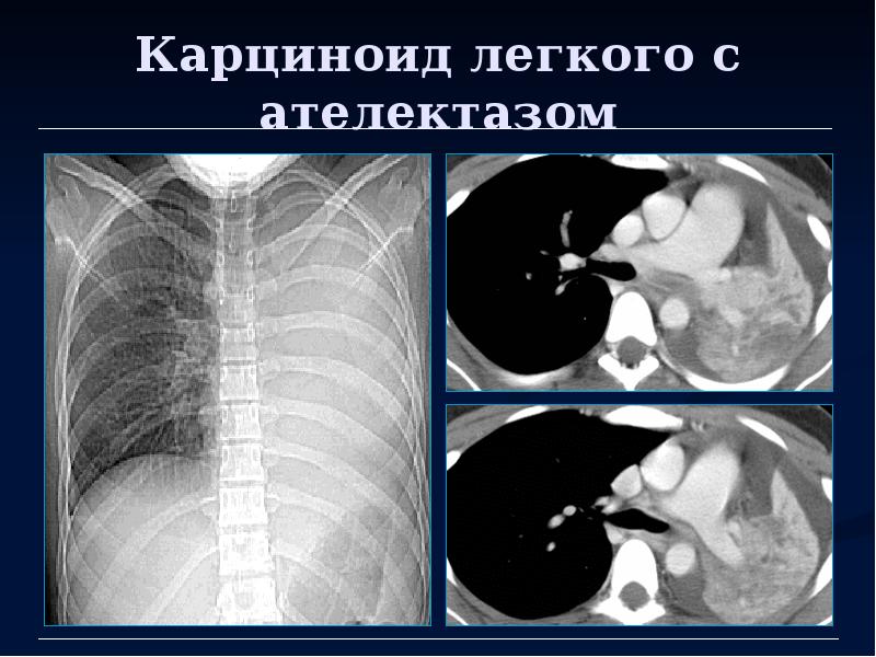 Ателектаз легкого кт картина