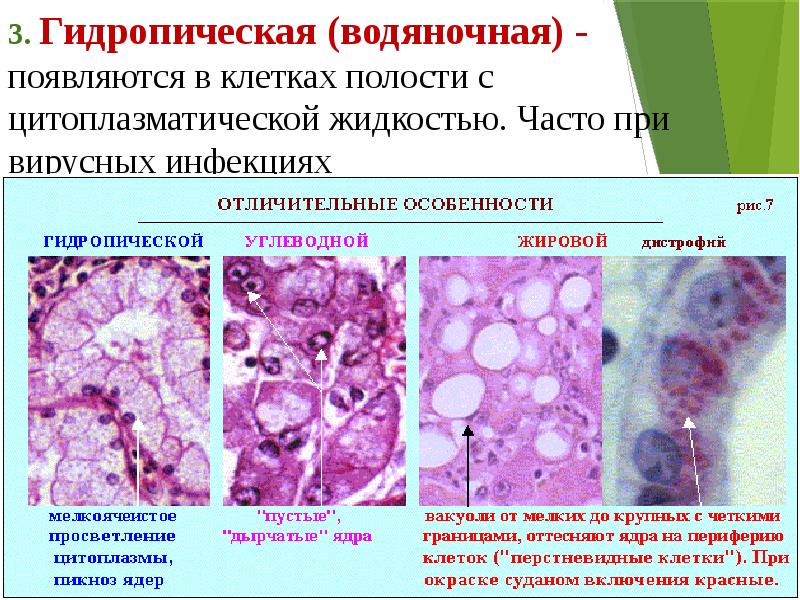 Дистрофия презентация патология