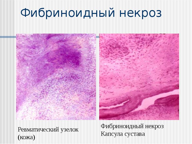 Фибриноидный некроз Фибриноидный некроз