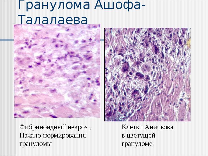 Гранулома Ашофа-Талалаева Гранулома Ашофа-Талалаева