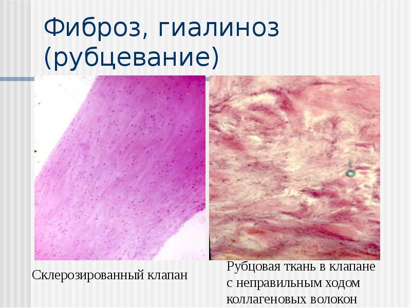 Фиброз, гиалиноз (рубцевание) Фиброз, гиалиноз (рубцевание)