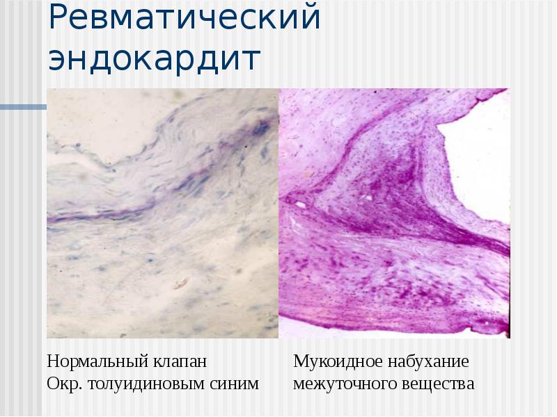 Ревматический эндокардит Ревматический эндокардит