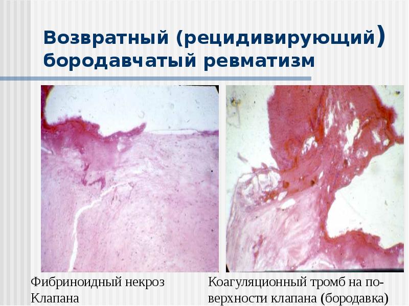 Возвратный (рецидивирующий) бородавчатый ревматизм Возвратный (рецидивирующий) бородавчатый ревматизм